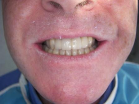 Dr Ghassan Dental Clinic | Qatar | Dental Bridges