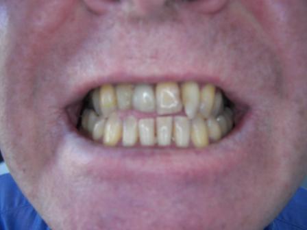 Dr Ghassan Dental Clinic | Qatar | Dental Bridges