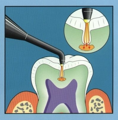 Dr Ghassan Dental Clinic | Qatar | Dental Laser