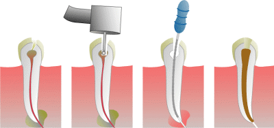 Dr Ghassan Dental Clinic | Qatar | Root Canal Treatment