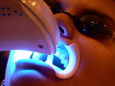 Dr Ghassan Dental Clinic | Qatar | Tooth Whitening