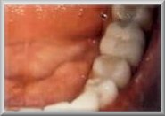 Dr Ghassan Dental Clinic | Qatar | White Dental Filling | After