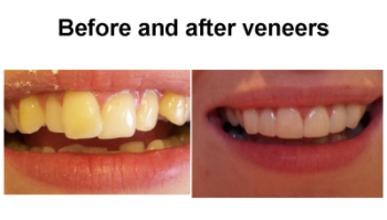 Dental Clinic Qatar | Malalligned teeth