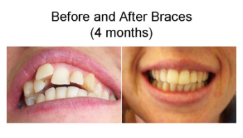 Dr Ghassan Dental Clinc | Qatar | Dental Braces before and after
