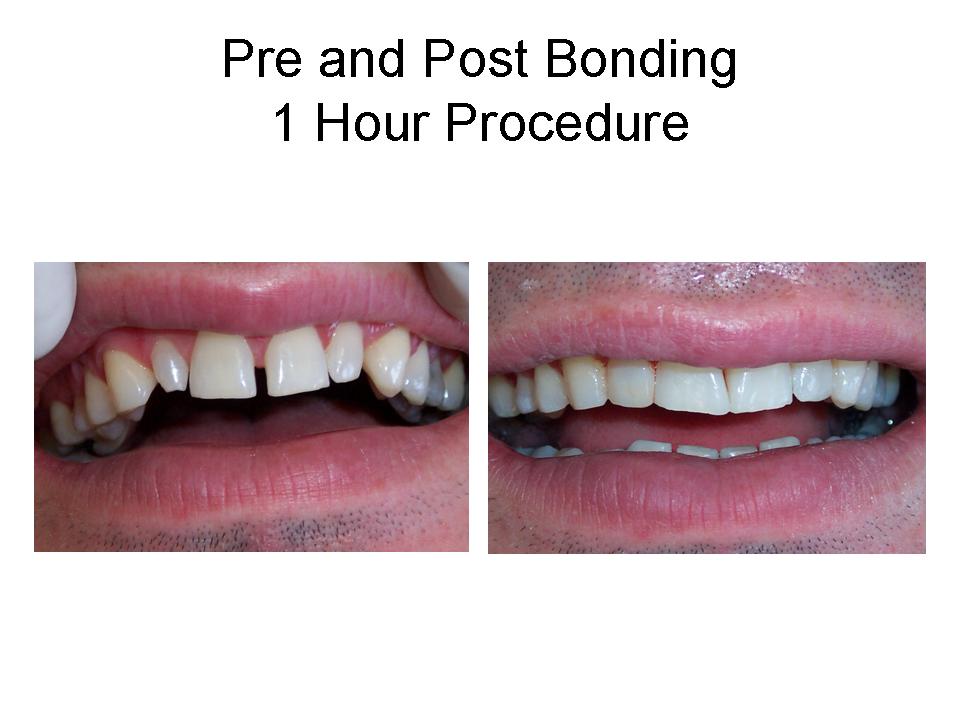 Dental Clinic Qatar | Composite Bonding