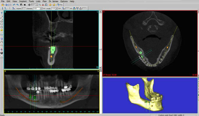 Dr Ghassan Dental Clinic | Qatar | CT Scan