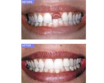 Dr Ghassan Dental Clinic | Qatar | Tooth Implants