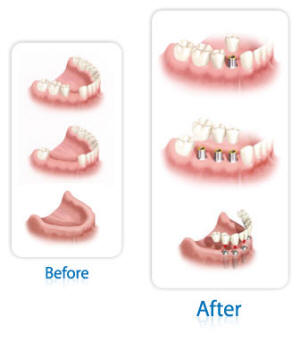 Dr Ghassan Dental Clinic | Qatar | Tooth Implants