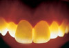 Dental Clinic | Qatar | Dental Crowns
